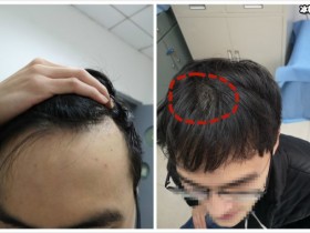 【APT扑克】脱发掉发严重发际线后移头发稀少你到底怎么了!